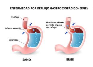 Reflujo Gastroesofagico Causas Diagnostico Y Tratamiento Meditip Images