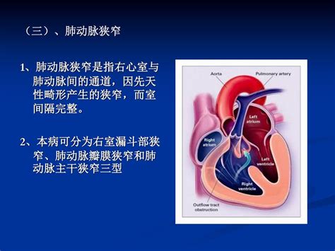 常见先天性心脏病 龙华医院肾内科 蔡小凡 Ppt Download