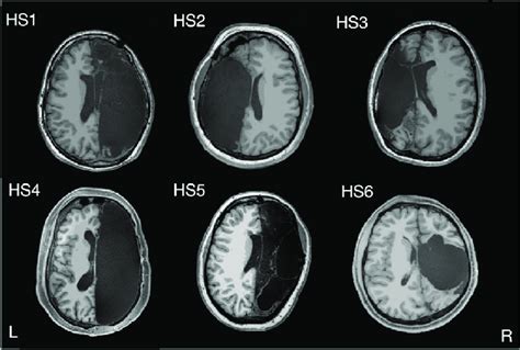 Hemispherectomy Brain Anatomy Six adult participants with left (n = 2,... | Download Scientific ...