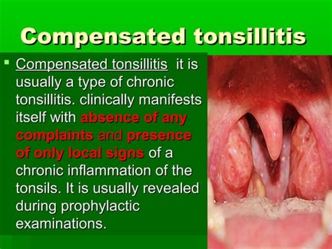 Acute And Chronic Tonsillitis And Their Management