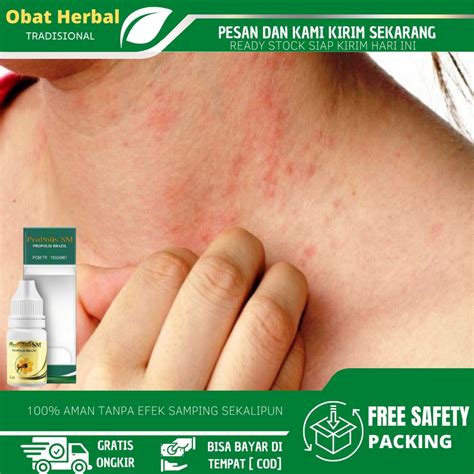 Jual Obat Biang Keringat Obat Bruntusan Gatal Ruam Merah Pada Bayi