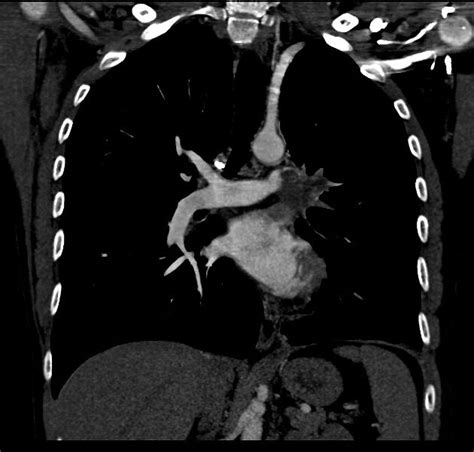 Pulmonary artery leiomyosarcoma | Radiology Case | Radiopaedia.org ...