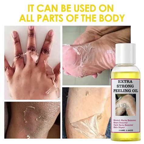 Private Label Extra Strong Peeling Oil Scar Remove Stretch Marks