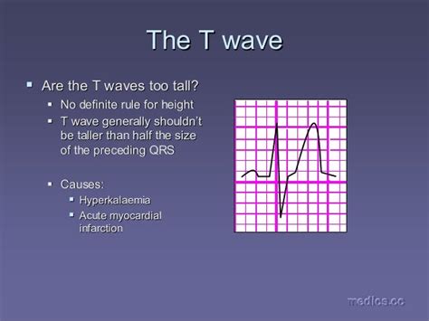 ECG