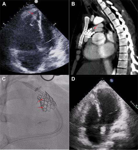 Life Saving Combination Of Extracorporeal Membrane Oxygenation