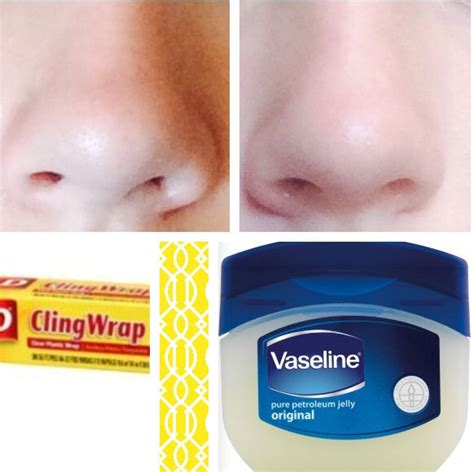 How To Get Rid Of Blackheads At Home With Vaseline Howotremvo