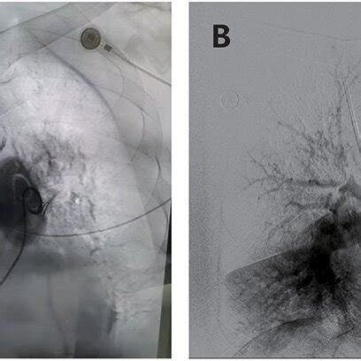 A Angiography Demonstrating Extensive Thrombus In Bilateral Pulmonary