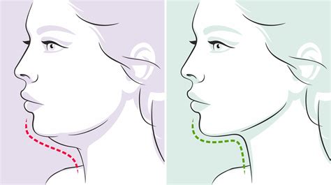 Génioplastie Comment se déroule la chirurgie esthétique du menton