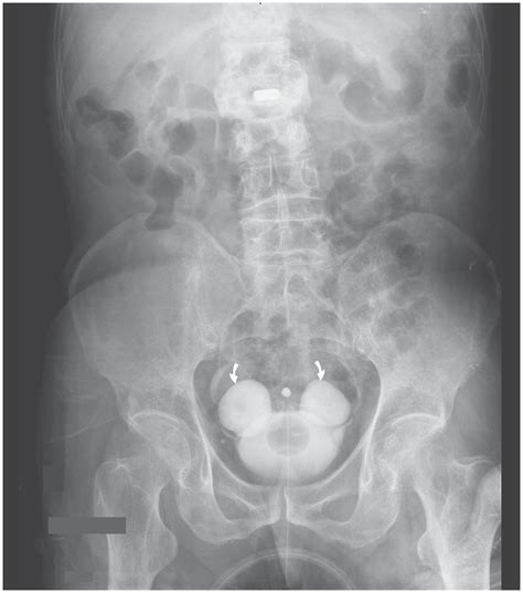 Bladder Diverticulum