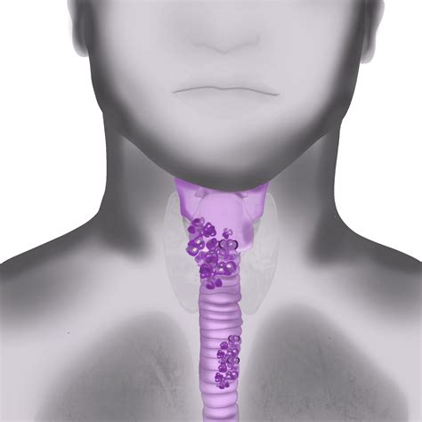 Pembrolizumab z trwałymi korzyściami w raku przełyku