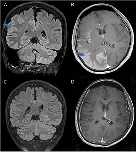 Teaching Neuroimages Neuroimaging In Hemiplegic Migraine Neurology