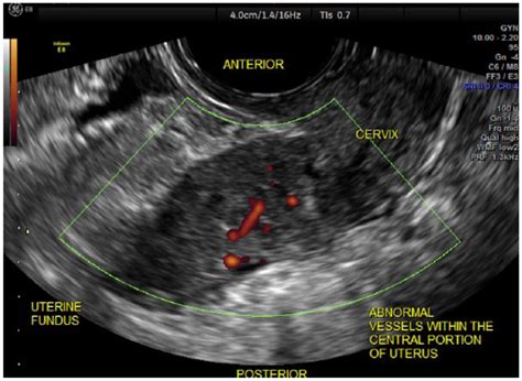 Predictive Value Of Three Dimensional Transvaginal Sonography For