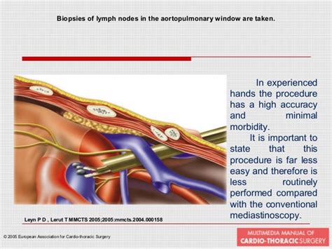 Mediastinoscopy And Mediastinotomy Indications And Techniques