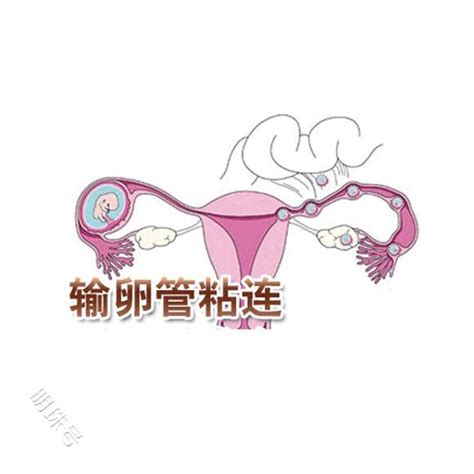 输卵管粘连症状有什么？女性疾病频道东方养生