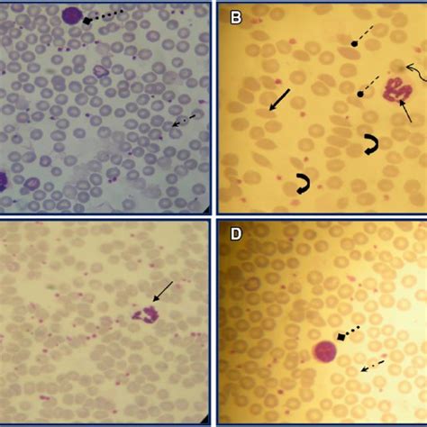 Erythrocytes Morphology Of Controls A Mm Treated B Download Scientific Diagram