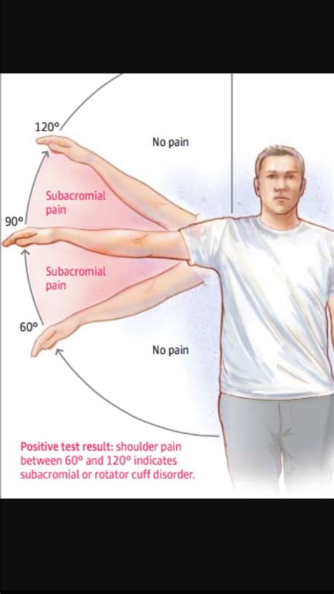 Subacromial Shoulder Impingement Syndrome 43 Off