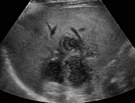 Liver Abscess Histology