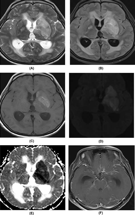 Figure From Tuberculous Meningitis With Stroke A Case Report Of