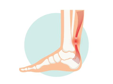 Achilles tendon rupture anatomical poster. Ankle injury, ligament ...