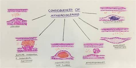 CONSEQUENCES OF ATHEROSCLEROTIC PLAQUE – Histopathology.guru