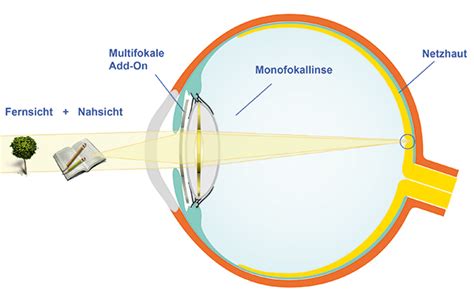 Add On Linsen Grauer Star Augenlaserklinik Saar