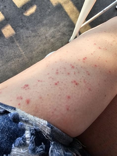 Please Help Me Figure Out What Kind Of Rash Us On Both Of My Outer Thighs 🙏 R Dermatologyquestions