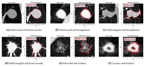 Sensors Free Full Text Lung Nodule Segmentation With A Region Based