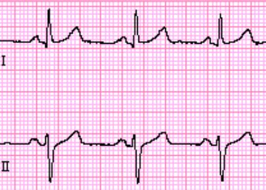 Left Anterior Fascicular Block - ECG Made Simple