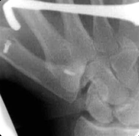 Volar Capsulodesis Of The Thumb Metacarpophalangeal Joint At The Time