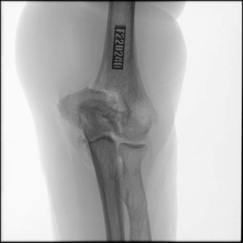 Fracture Of Distal Humerus Left