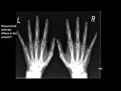 Osteoarthritis Hands X Ray