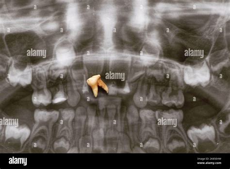 La imagen panorámica muestra varios dientes incrustados e impactados