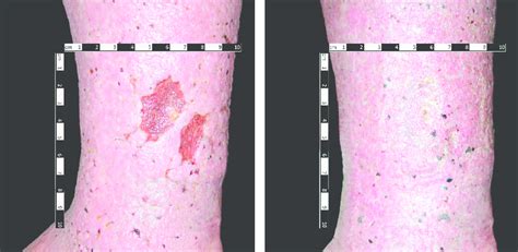 An example of a completely healed wound after three stages of treatment ...