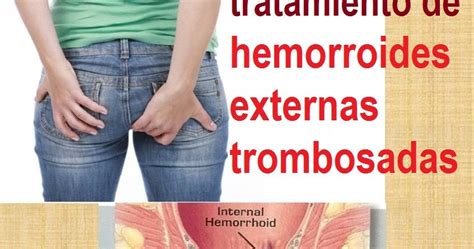 Tratamiento De Hemorroides Externas Trombosadas Medicina Natural No