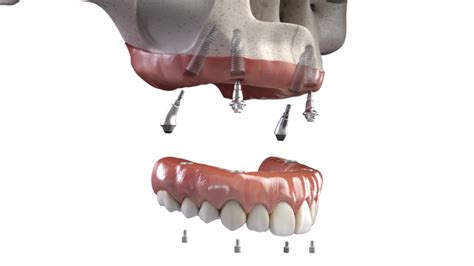 All On X Dental Implants Beaumont Dental Center