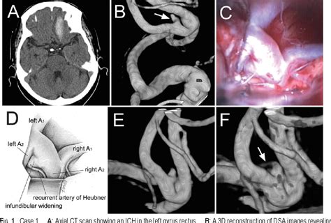 Figure 1 From Infundibular Widening Mimicking Anterior Communicating Artery Aneurysm Report Of