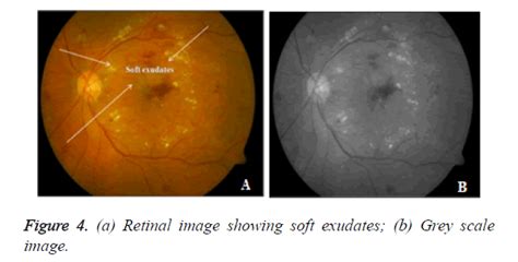 An efficient approach for detecting exudates in diabetic retinopathy images