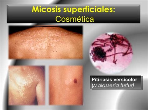 Micosis