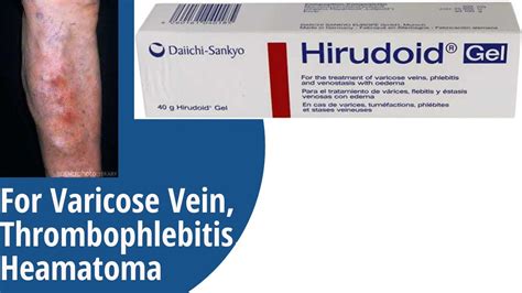 Hirudoid Gel For Varicose Vein Thrombophlebitis Hematoma Uses And