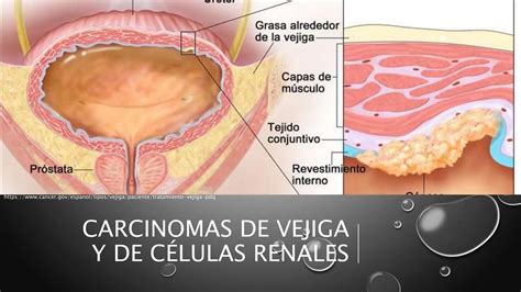 Carcinomas De Vejiga Y Celulas Renales C Enfermedades Prostata