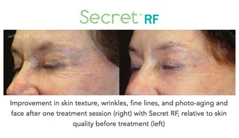 ¿microneedling Tradicional O Rf ¿qué Es Mejor Cutera