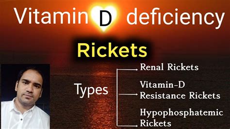 Vitamin D Deficiency Rickets And Types Of Rickets Renalvitamin D