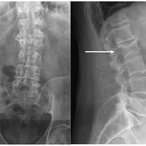 Radiography Of The Lumbar Spine A Antero Posterior View B Lateral