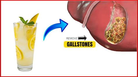 How To Dissolve Gallstones Without Surgery Natural Home Remedies Natural Home Remedies Home