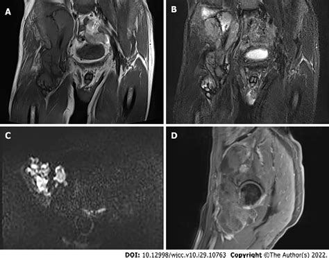 Figure 3 From Malignant Giant Cell Tumors Of The Tendon Sheath Of The Right Hip A Case Report