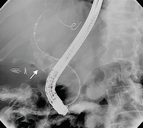 Ercp Demonstrating Radiolucent Filling Defects In A Dilated Cbd In A Download Scientific