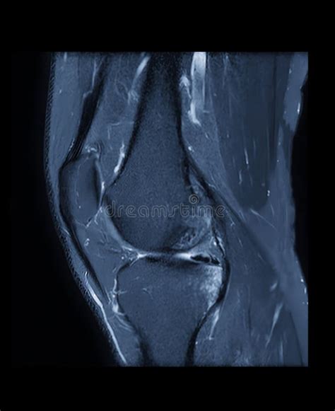 Compare Of Mri Knee Or Magnetic Resonance Imaging Of Knee Joint Stir