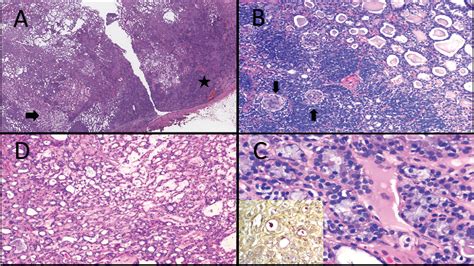 Figure From Primary Cutaneous Adenomyoepithelioma Ex Spiradenoma With