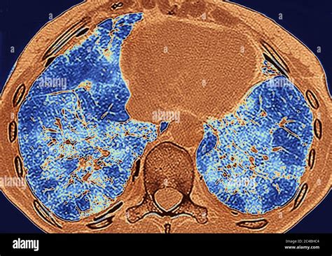 Fibrosis Pulmonar Histologia Fotografías E Imágenes De Alta Resolución