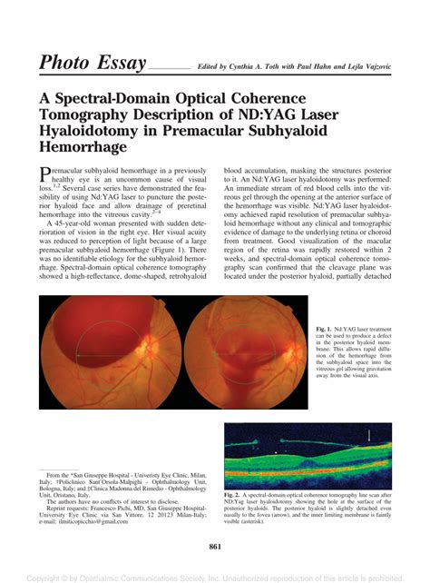 PDF A Spectral Domain Optical Coherence Tomography Description Of ND